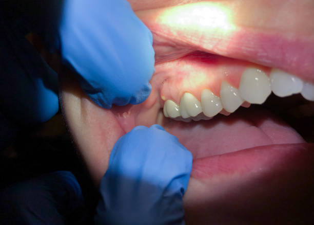 Best Emergency Tooth Extraction in New Vienna, OH