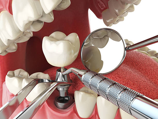 Best Emergency Root Canal Treatment in New Vienna, OH